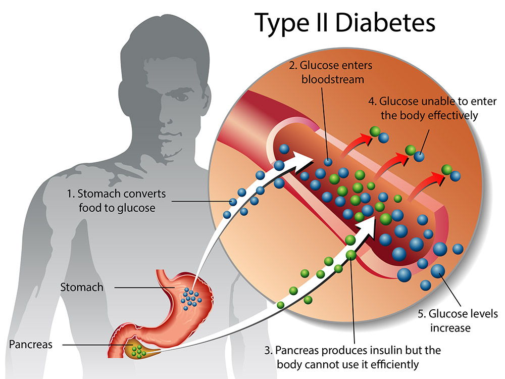 Type 2 Diabetes Complications: From Neuropathy to Retinopathy